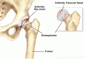 hip_arthritis