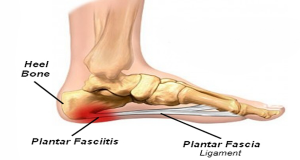 plantar-fasciitis