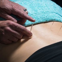 dryneedling