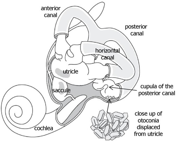 benign paroxysmal positional vertigo